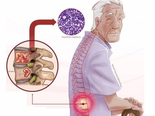 Estudo analisa sobrevida livre de progressÃ£o em pacientes com mieloma