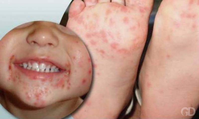 CuiabÃ¡ tem surto de sÃ­ndrome mÃ£o-pÃ©-boca e SaÃºde orienta populaÃ§Ã£o