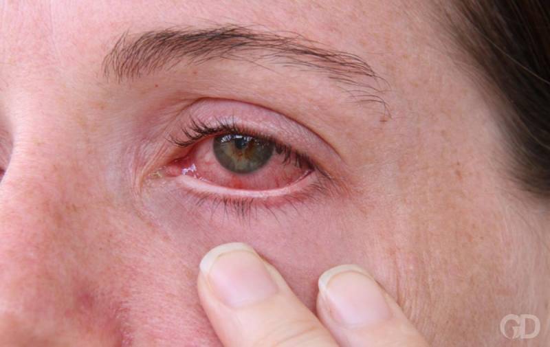 Surto de gripe traz 'epidemia' de conjuntivite, alerta oftalmologista