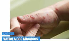 SaÃºde monitora sete casos suspeitos de varÃ­ola dos macacos