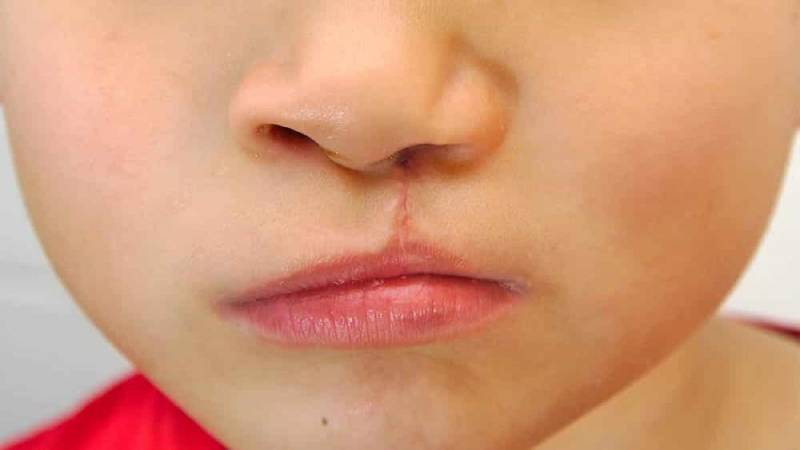 Hospitais de CuiabÃ¡ devem notificar nascimento de bebÃªs com fissura labiopalatina