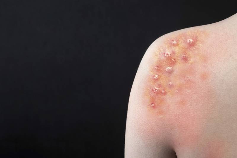 Sobe para 142 o nÃºmero de casos de varÃ­ola dos macacos