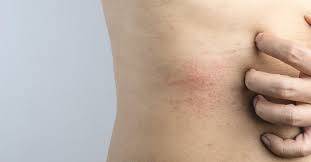 ApÃ³s registros de sarna humana, Secretaria de SaÃºde de CÃ¡ceres (MT) alerta risco para a doenÃ§a