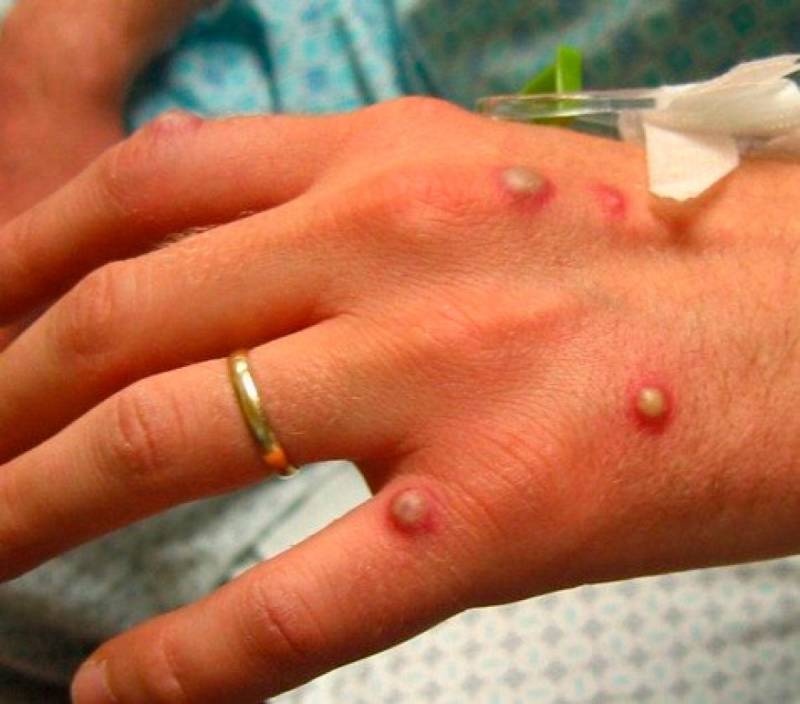 Cerca de 42% da populaÃ§Ã£o nÃ£o tem conhecimento sobre varÃ­ola do macaco