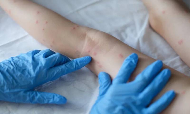 ALERTA- VG registra dois casos suspeitos de varÃ­ola dos macacos