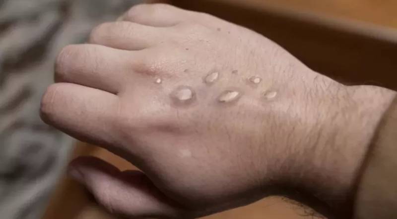 MinistÃ©rio da SaÃºde confirma 8Âª morte por varÃ­ola dos macacos no paÃ­s