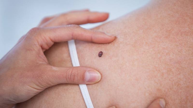 Sociedade Brasileira de Dermatologia oferecerÃ¡ exames preventivos de cÃ¢ncer da pele no prÃ³ximo sÃ¡bad